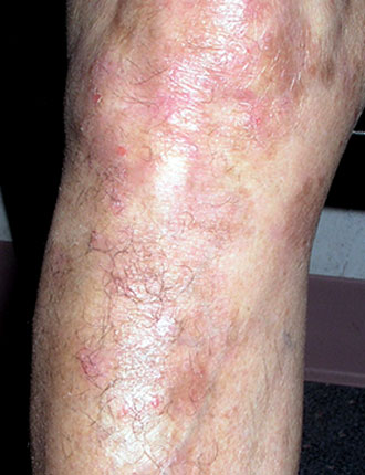 Xtrac Laser Treats Psoriasis And Vitiligo