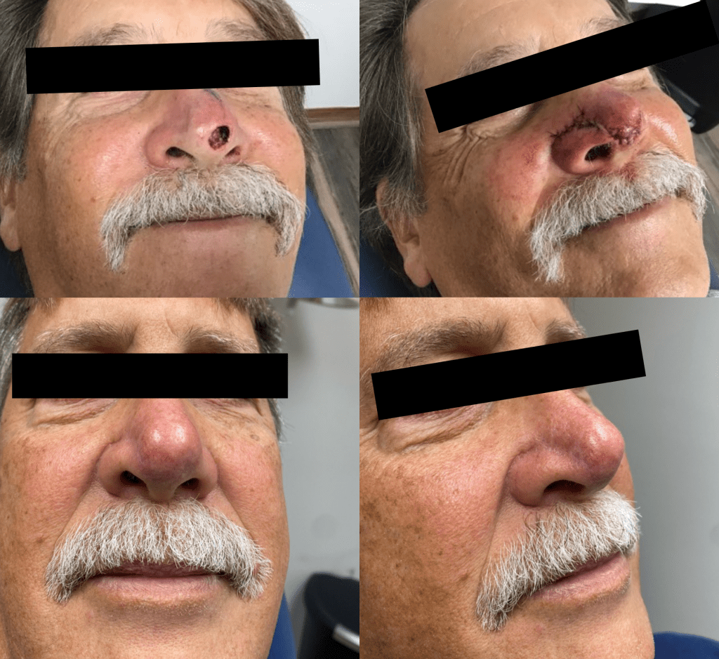 Mohs Surgery at Melbourne Dermatology Before and After photos
